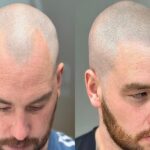 Scalp Micropigmentation Liverpool