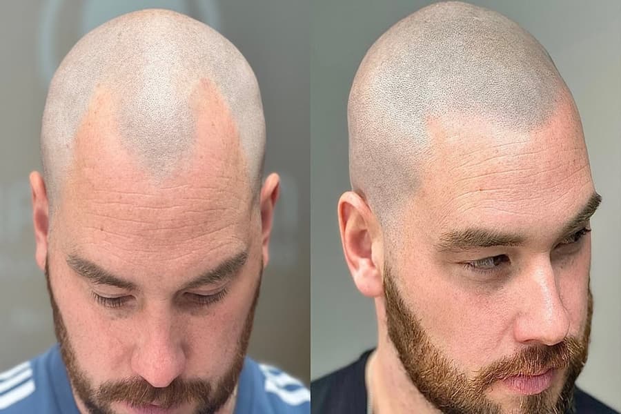 Scalp Micropigmentation Liverpool